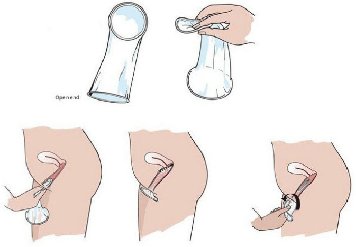 Ảnh minh họa - Cách sử dụng bao cao su dành cho nữ giới