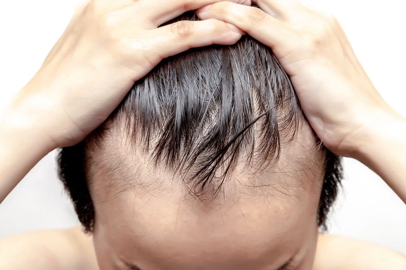 Di truyền là một trong những nguyên nhân gây ra hói đầu ở đàn ông