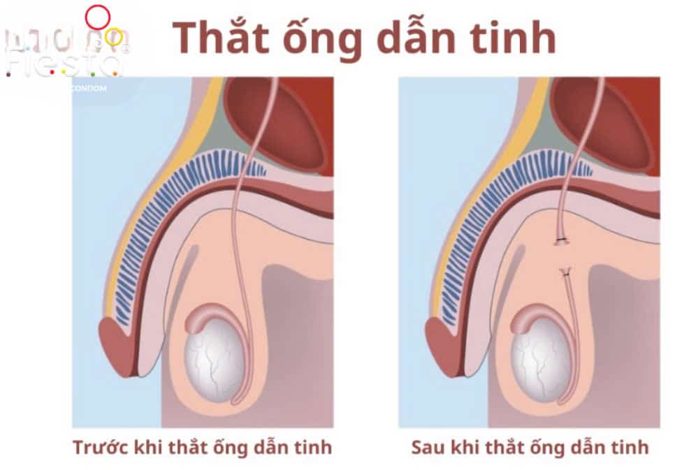 Trước và sau khi thực hiện thắt ống dẫn tinh.