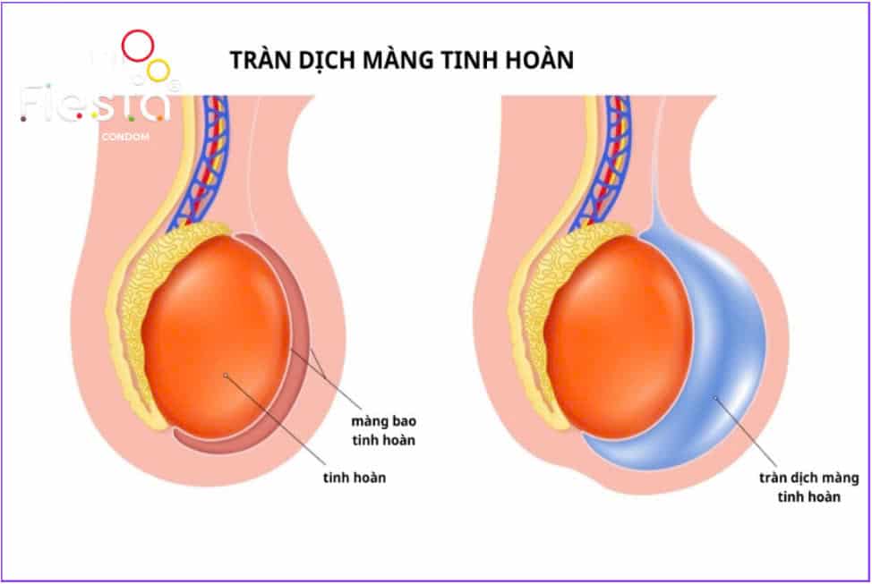 Tràn dịch màng tinh hoàn (hydrocele) là một biến chứng không gây nguy hiểm, có thể gặp phải sau khi thắt ống dẫn tinh.