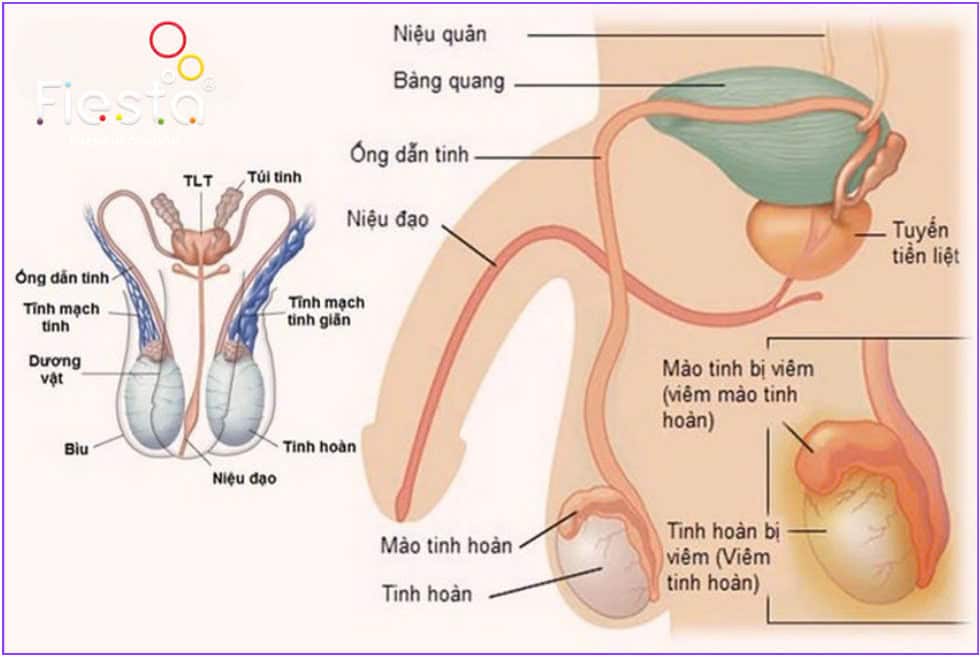 Hình ảnh giãn tĩnh mạch thừng tinh