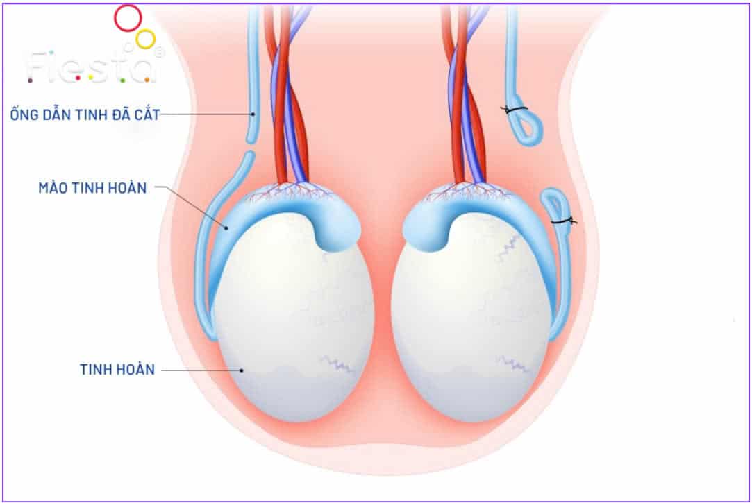 Quy trình triệt sản nam.